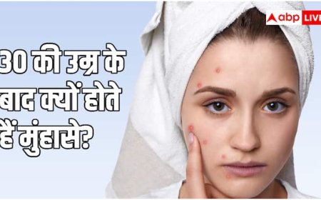 30 साल के हो गए हैं फिर भी पीछा नहीं छोड़ रहे मुंहासे? ये हो सकती है वजह