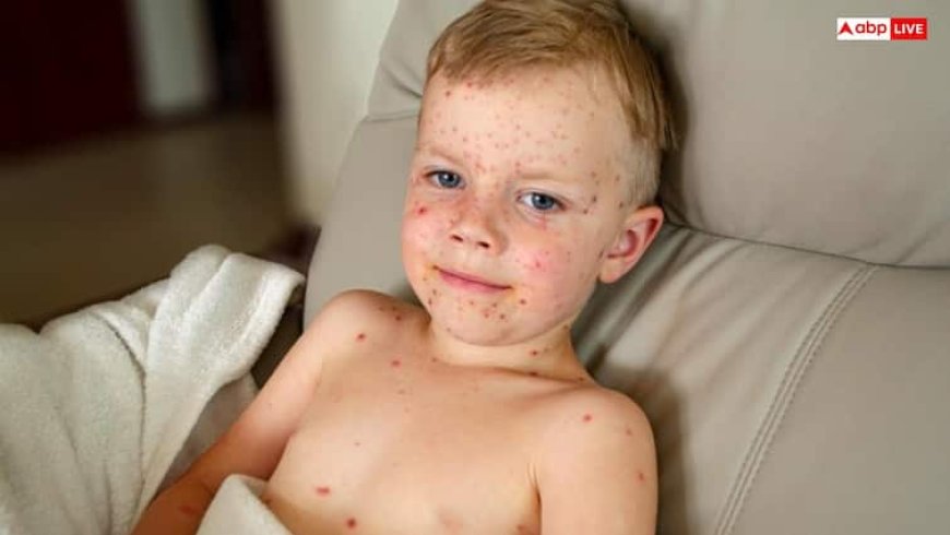 Measles in USA: इस खतरनाक बीमारी की चपेट में आया अमेरिका, टेक्सास में 700 से ज्यादा बीमार