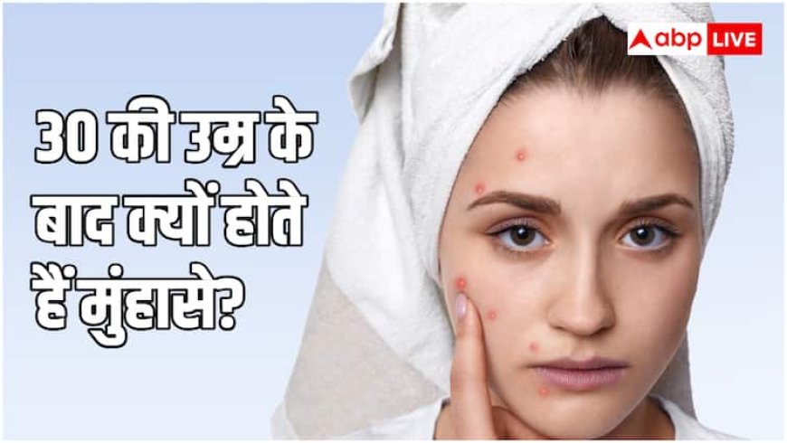 30 साल के हो गए हैं फिर भी पीछा नहीं छोड़ रहे मुंहासे? ये हो सकती है वजह