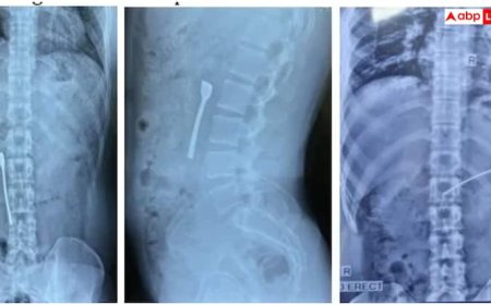 दवाई के साथ स्टील की चम्मच भी निगल गया यह शख्स, जानें डॉक्टरों ने पेट से कैसे निकाला बाहर?