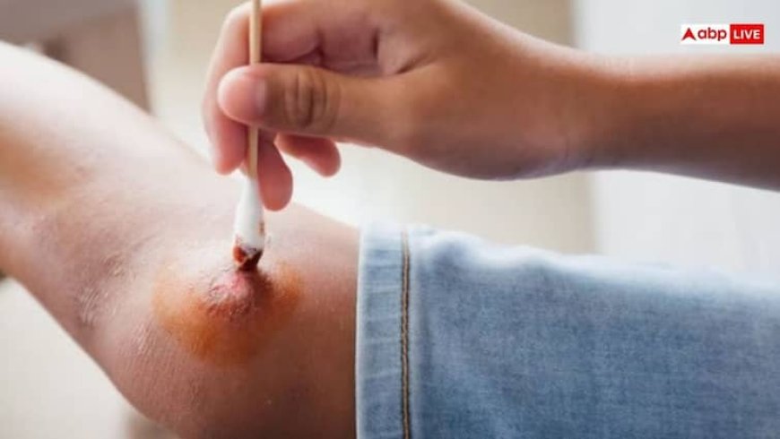 चोट लगने से आने लगे खून तो सबसे पहले करें ये काम, एक गलती भी हो सकती है खतरनाक