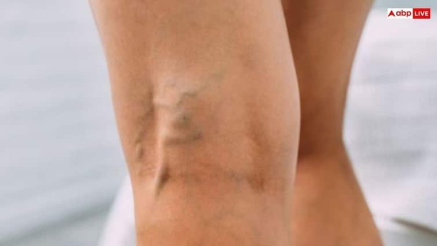 ये 6 कारण जिससे दिखने लगती हैं पैरों की नसें, कहीं आप तो नहीं हैं इनके शिकार