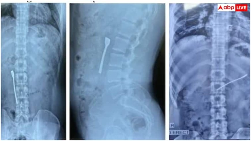 दवाई के साथ स्टील की चम्मच भी निगल गया यह शख्स, जानें डॉक्टरों ने पेट से कैसे निकाला बाहर?