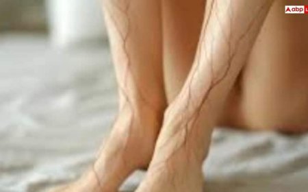 पैरों पर बनने लगे हैं मकड़ी जैसे जाले तो हो जाएं सावधान, इस खतरनाक बीमारी का है लक्षण