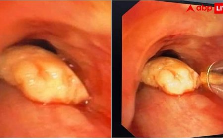 महिला की सांस की नली में फंस गया काजू, AIIMS के डॉक्टरों ने ऐसे बचाई जान