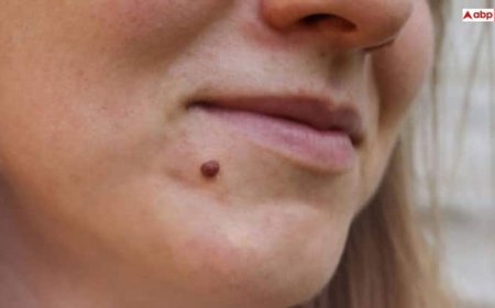 शरीर में क्यों निकलने लगते हैं मस्से, कब होती है खतरे की घंटी; जानिए इलाज