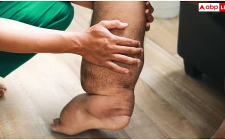 भारत के किस राज्य में फाइलेरिया के सबसे ज्यादा मरीज, किस वजह से होती है यह बीमारी और कितनी खतरनाक?
