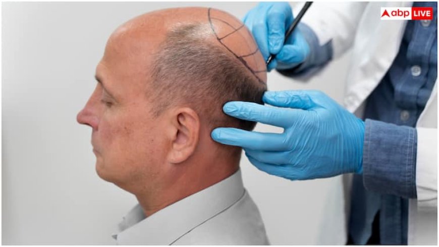 हेयर ट्रांसप्लांट से पहले ये वाला टेस्ट होता है जरूरी, नहीं तो जा सकती है जान
