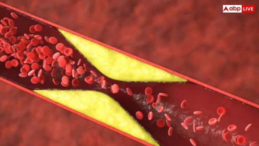 कोलेस्ट्रॉल बढ़ने पर आंखों में दिखते हैं ये बदलाव, जानें लक्षण