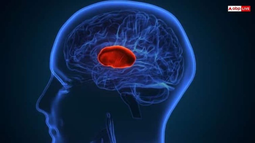 ब्रेन हैमरेज होने के कितने देर तक जिंदा रहता है इंसान, जानें सबसे पहले क्या करें