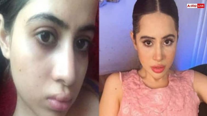 क्या है लिप फिलर, जिसे हटवाने के बाद सूज गया उर्फी जावेद का चेहरा?