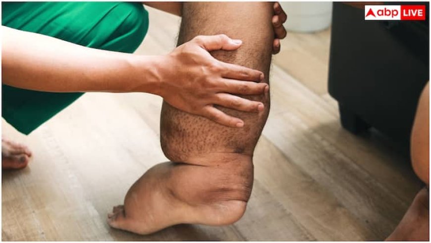 भारत के किस राज्य में फाइलेरिया के सबसे ज्यादा मरीज, किस वजह से होती है यह बीमारी और कितनी खतरनाक?
