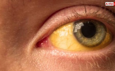 पीलिया को नजरअंदाज करना पड़ सकता है भारी! घर बैठे इस तरह करें पहचान