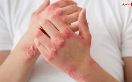 स्किन पर भी होता है फंगल इन्फेक्शन, जानिए इसे कम करने के आसान से उपाय