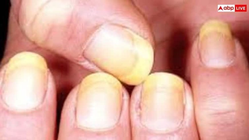 किस विटामिन की कमी से पीले होते हैं नाखून, जानें कैसे करें इसकी पूर्ति?