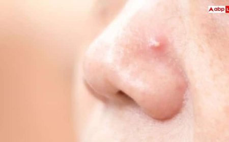 नाक के पास होने वाला दाना तो नहीं फोड़ देते हैं आप? हो सकती हैं ये लाइलाज दिक्कतें