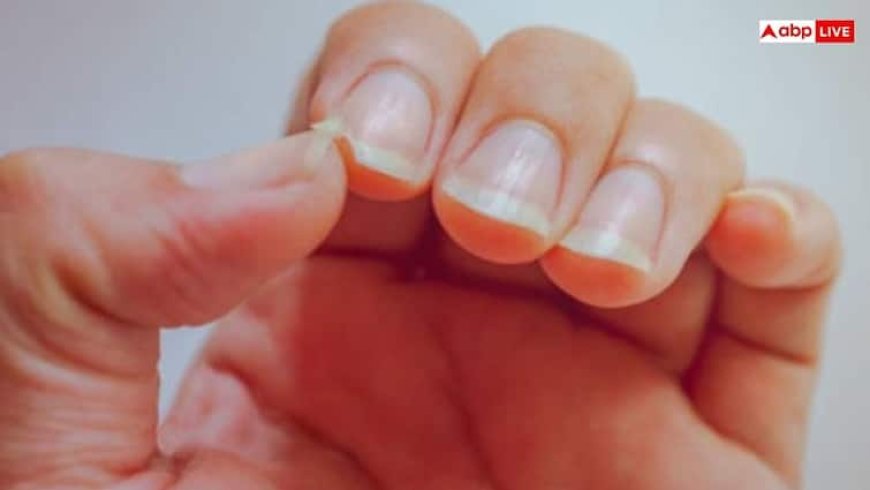 Nail Marks Symptoms: नाखून के ऊपर दिख रहा है ये निशान तो समझ लीजिए इस चीज की हो गई कमी, कई इशारे करते हैं हमारे नाखून