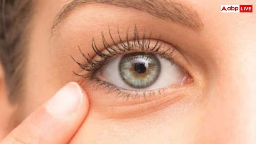 Alum for Dark Circle: डार्क सर्कल्स कम करने के लिए एलम का इस्तेमाल, क्या यह प्राकृतिक उपाय सच में काम करता है?