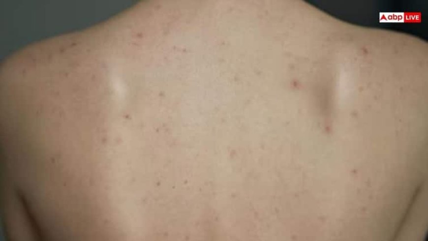 Home Remedies for Back Acne: पीठ पर होने वाले मुंहासे से हैं परेशान? अपनाएं ये आसान घरेलू नुस्खे