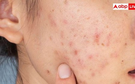 कील-मुंहासों से आपके चेहरे पर भी हो गए हैं गड्ढे, जानें इन्हें कैसे भरें?