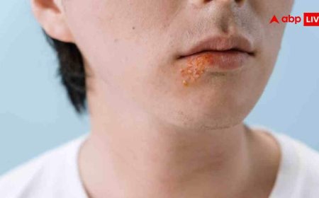 Zoster Infection क्या है? जानें इस वायरल बीमारी की हर एक डिटेल