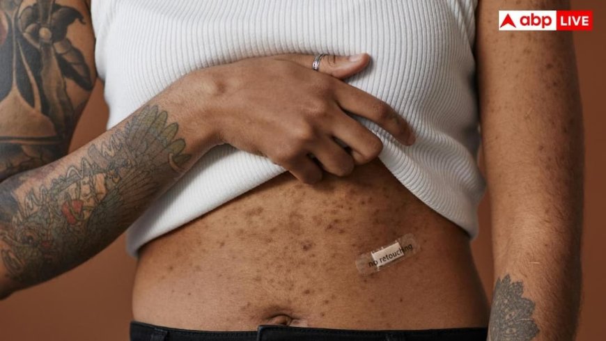 किन लोगों को हो जाती है सोराइसिस की बीमारी, इससे कैसे बचें?