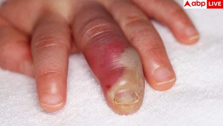 Winter Finger Swelling: ठंड में क्यों सूज जाती हैं अंगुलियां, क्या है इनका सटीक इलाज?
