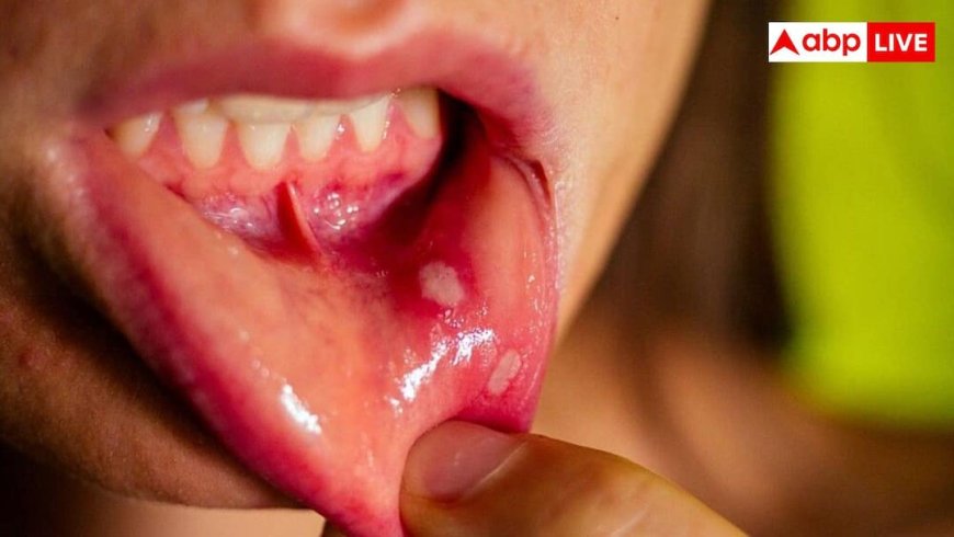 बार-बार मुंह में हो रहे हैं छाले तो न करें नजरअंदाज, हो सकती है यह लाइलाज बीमारी
