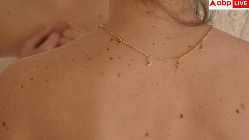 Psoriasis Symptoms: क्या सच में नहीं होता सोराइसिस का कोई इलाज, जानें कितनी खतरनाक है यह बीमारी?