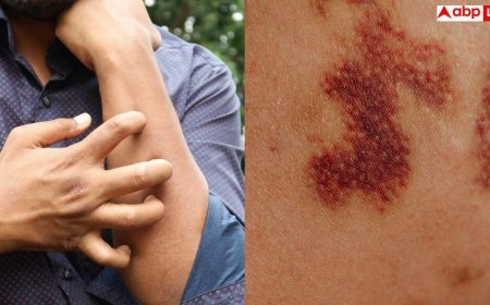 Blood Cancer Symptoms: स्किन पर लगातार दिख रहे लाल चकत्ते तो तुरंत कराएं सीबीसी, हो सकता है ब्लड कैंसर