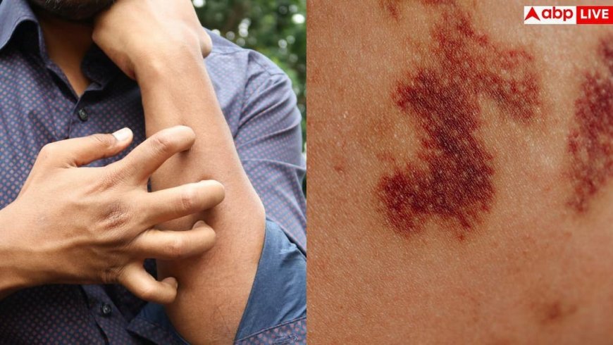 Blood Cancer Symptoms: स्किन पर लगातार दिख रहे लाल चकत्ते तो तुरंत कराएं सीबीसी, हो सकता है ब्लड कैंसर