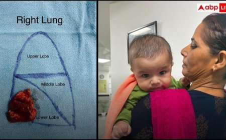 AIIMS Delhi ने रचा इतिहास! 4 महीने के मासूम की दुनिया की सबसे दुर्लभ लंग सर्जरी सफल