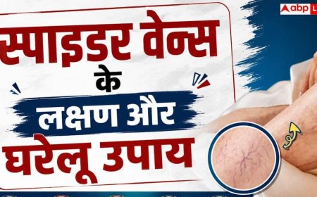 Spider Veins: आपके पापा के पैर में दिख रहे मकड़ी जैसे जाले, कितनी गंभीर है यह समस्या?