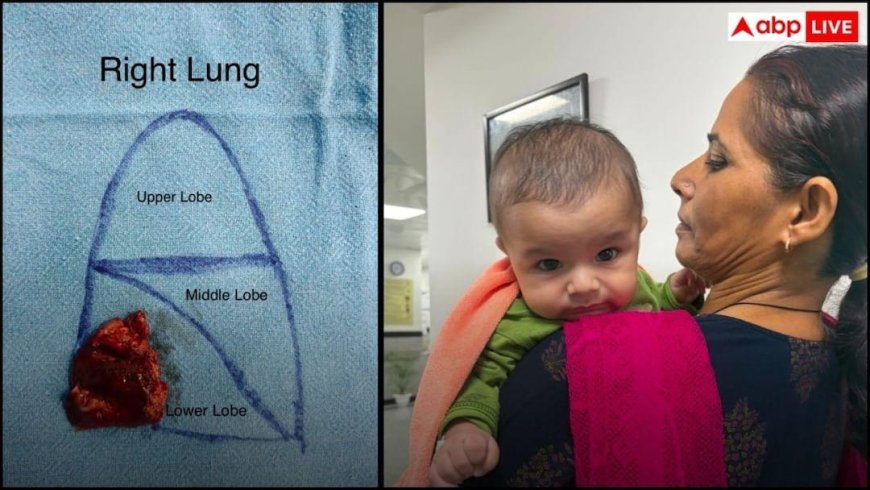 AIIMS Delhi ने रचा इतिहास! 4 महीने के मासूम की दुनिया की सबसे दुर्लभ लंग सर्जरी सफल