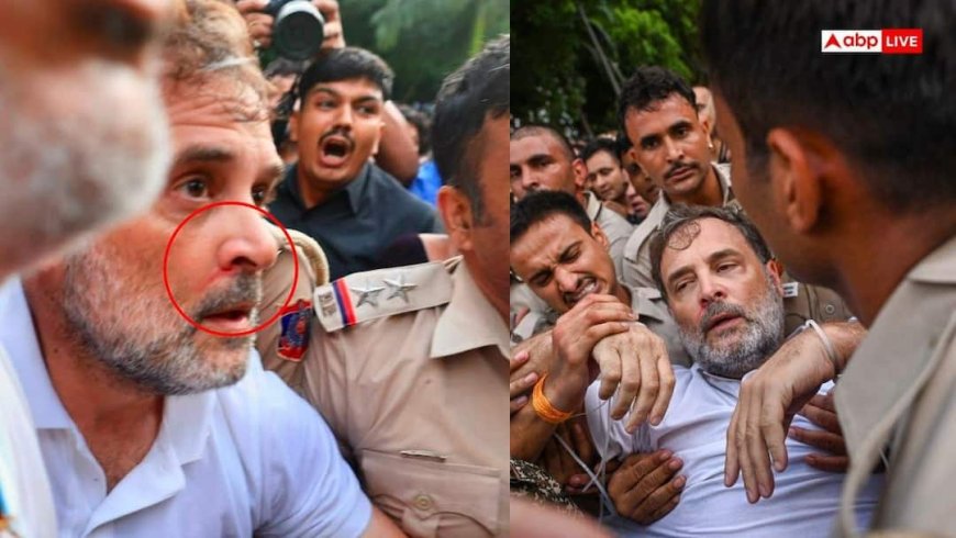नाक से बहा खून, छाती पर चोट..., प्रदर्शन के दौरान राहुल गांधी के घायल होने की आई तस्वीर