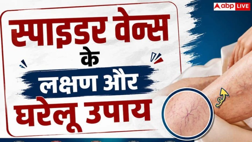 Spider Veins: आपके पापा के पैर में दिख रहे मकड़ी जैसे जाले, कितनी गंभीर है यह समस्या?