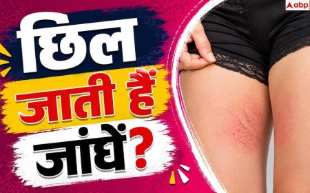 How To Prevent Chafing: जांघे छिलने से हैं परेशान? इन तरीकों से जिंदगी भर के लिए मिल जाएगा आराम
