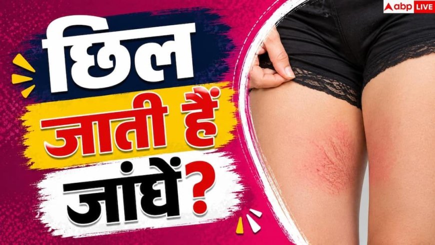 How To Prevent Chafing: जांघे छिलने से हैं परेशान? इन तरीकों से जिंदगी भर के लिए मिल जाएगा आराम